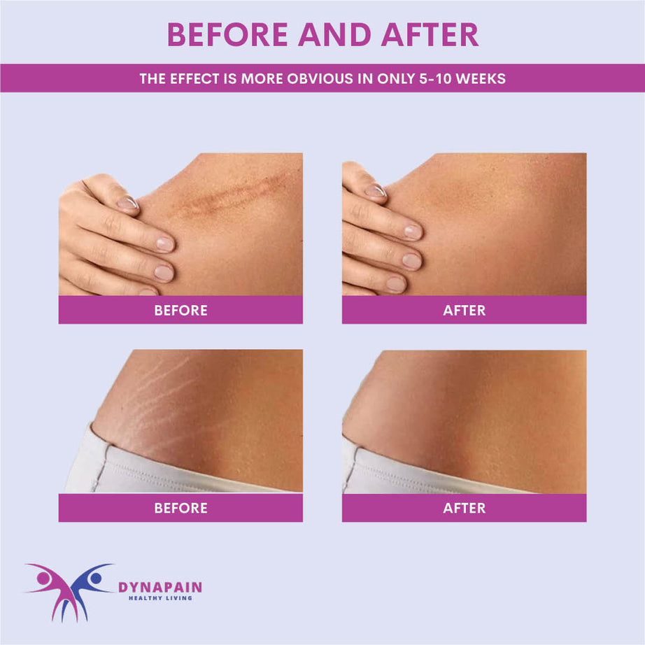 Medical Grade Silicone Scar Sheets, Silicone Scar Strips